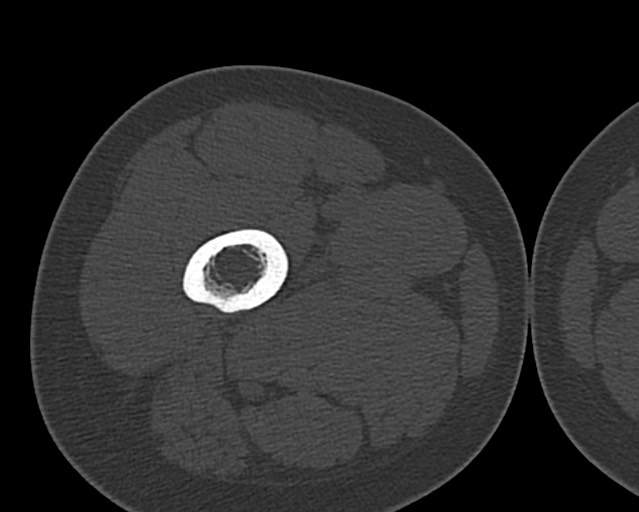 Chronic ostemyelitis of the femur with long sinus tract (Radiopaedia 74947-85982 Axial bone window 54).jpg