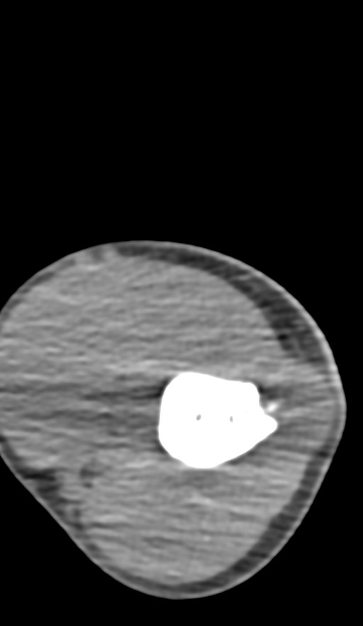 Chronic osteomyelitis of the distal humerus (Radiopaedia 78351-90971 Axial non-contrast 58).jpg