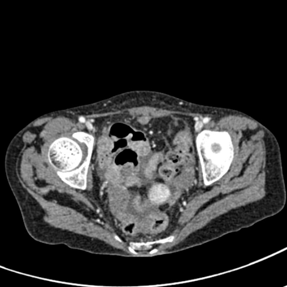 Chronic pancreatitis (Radiopaedia 55405-61846 A 97).jpg