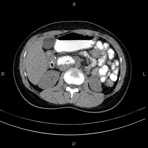 Chronic pancreatitis (Radiopaedia 64576-73450 Axial non-contrast 67).jpg