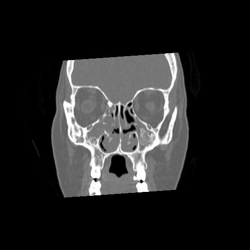 File:Chronic sinusitis with intra-sinus calcification (Radiopaedia 63919-72668 Coronal bone window 11).jpg