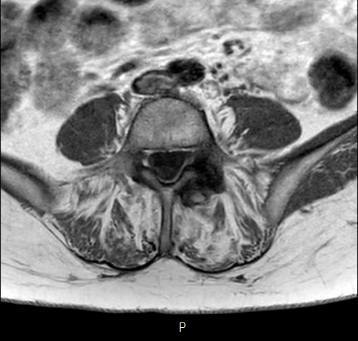 File:Chronic spinal hematoma with cauda equina syndrome (Radiopaedia 75745-87090 Axial T1 23).png