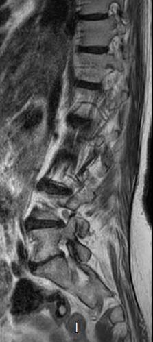 File:Chronic spinal hematoma with cauda equina syndrome (Radiopaedia 75745-87090 Sagittal T2 11).png