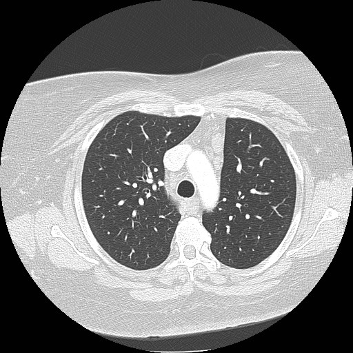 File:Cicatrisation collapse (Radiopaedia 17405-17089 lung window 36).jpg