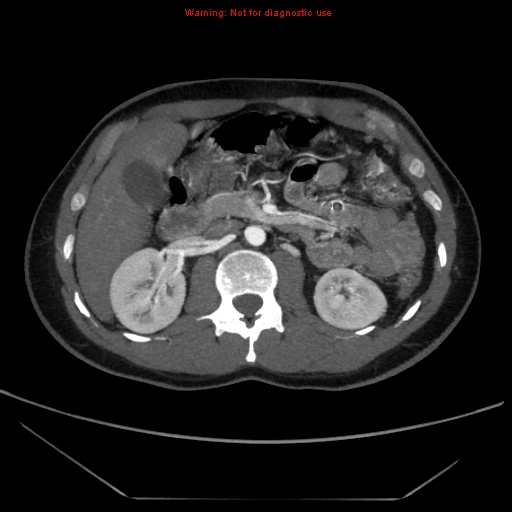 File:Circumaortic left renal vein (Radiopaedia 9069-9792 A 20).jpg