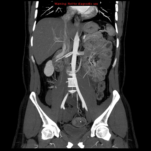 File:Circumaortic left renal vein (Radiopaedia 9069-9792 B 17).jpg