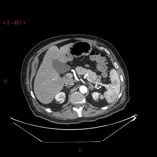 Circumaortic left renal vein and doubled left renal arteries (Radiopaedia 52268-58158 A 17).jpg