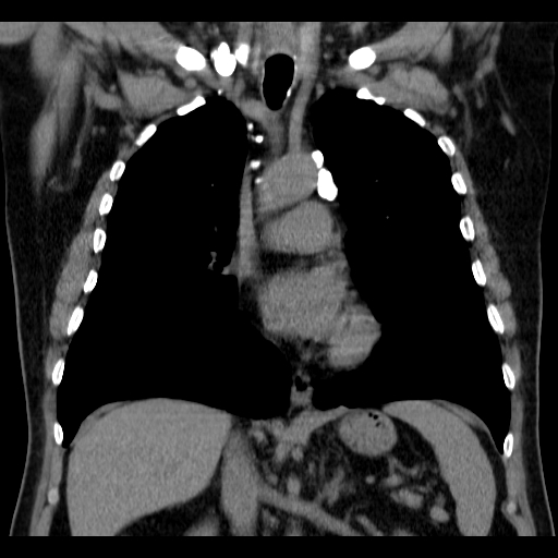 File:Classic complicated silicosis (Radiopaedia 49720-54961 Coronal liver window 28).jpg