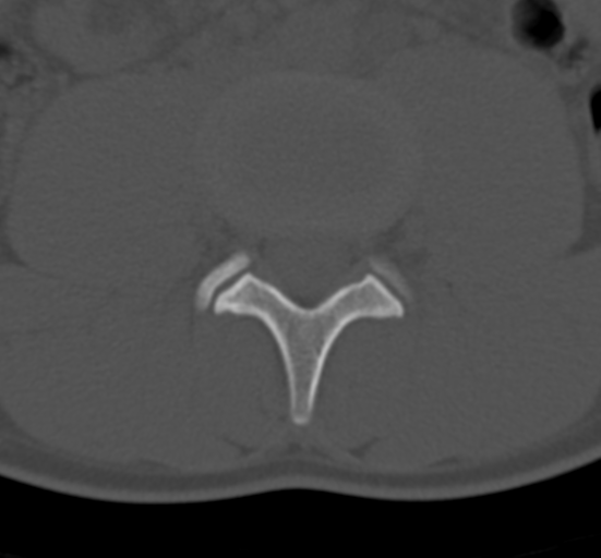Clear cell meningoma - lumbar spine (Radiopaedia 60116-67691 Axial bone window 44).png