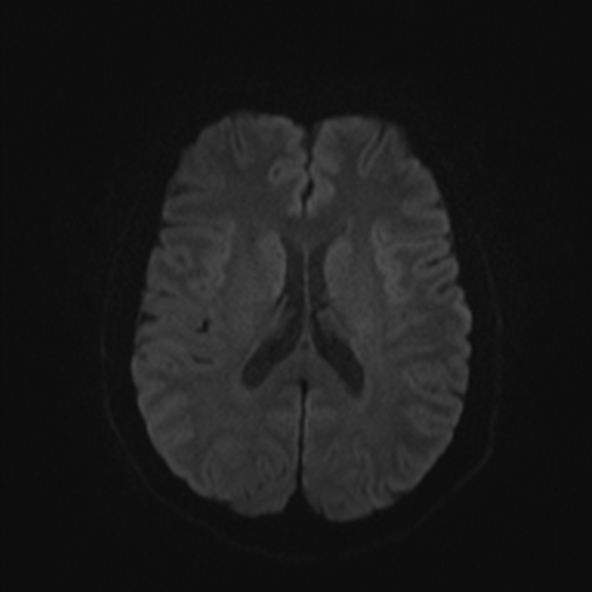 File:Clival meningioma (Radiopaedia 53278-59248 Axial DWI 40).jpg