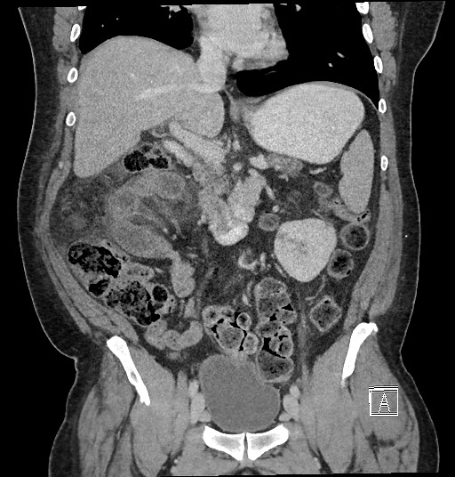 Closed loop obstruction - internal hernia into nephrectomy bed (Radiopaedia 59867-67320 B 65).jpg