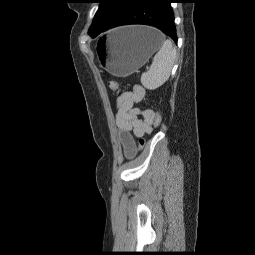Closed loop small bowel obstruction (Radiopaedia 65403-74451 C 92).jpg