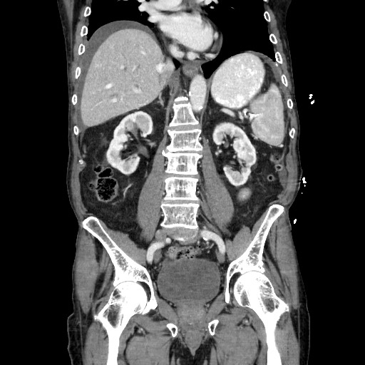 Closed loop small bowel obstruction - adhesive disease and hemorrhagic ischemia (Radiopaedia 86831-102990 B 78).jpg