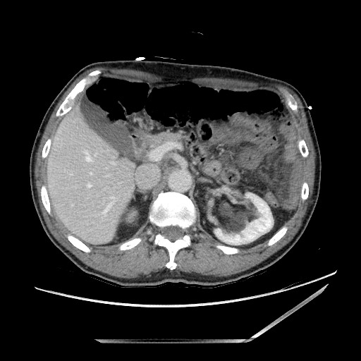 File:Closed loop small bowel obstruction - omental adhesion causing "internal hernia" (Radiopaedia 85129-100682 Axial 103).jpg