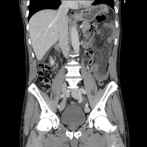Closed loop small bowel obstruction - omental adhesion causing "internal hernia" (Radiopaedia 85129-100682 B 68).jpg