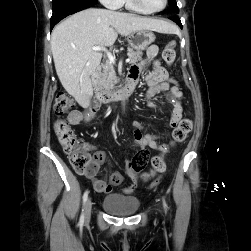 Closed loop small bowel obstruction due to adhesive bands - early and late images (Radiopaedia 83830-99014 B 52).jpg