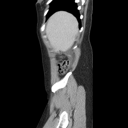Closed loop small bowel obstruction due to trans-omental herniation (Radiopaedia 35593-37109 C 10).jpg