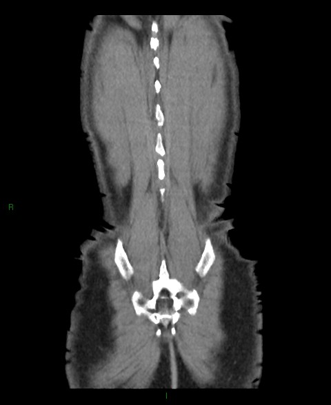 Closed loop small bowel obstruction with ischemia (Radiopaedia 84180-99456 B 2).jpg
