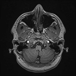 Cochlear incomplete partition type III associated with hypothalamic hamartoma (Radiopaedia 88756-105498 Axial T1 44).jpg