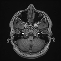 File:Cochlear incomplete partition type III associated with hypothalamic hamartoma (Radiopaedia 88756-105498 Axial T1 49).jpg