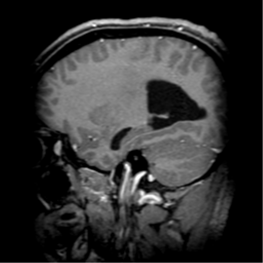 File:Colloid cyst (Radiopaedia 53164-59125 F 25).png
