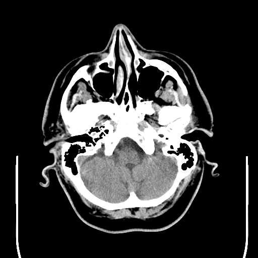 File:Colloid cyst (large) (Radiopaedia 34415-35734 Axial non-contrast 13).png