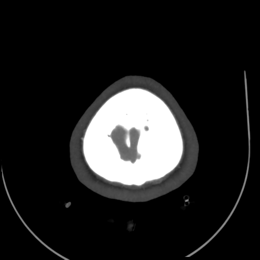Colloid cyst (resulting in death) (Radiopaedia 33423-34499 A 56).png
