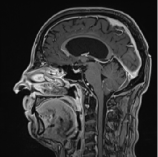 File:Colloid cyst of the third ventricle (Radiopaedia 86571-102662 Sagittal T1 C+ 38).png