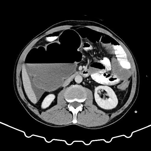Colocolic intussusception due to large lipoma (Radiopaedia 68773-78482 A 81).jpg