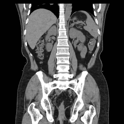 File:Colocutaneous fistula in Crohn's disease (Radiopaedia 29586-30093 Coronal non-contrast 27).jpg