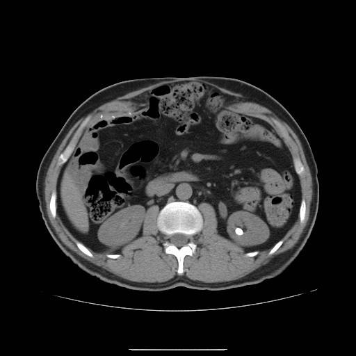 File:Colocutaneous fistula in Crohn's disease (Radiopaedia 29586-30093 D 2).jpg