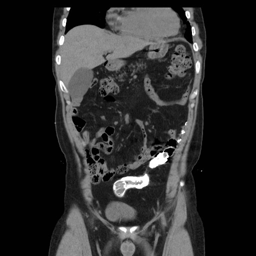 File:Colocutaneous fistula in Crohn's disease (Radiopaedia 29586-30093 E 7).jpg