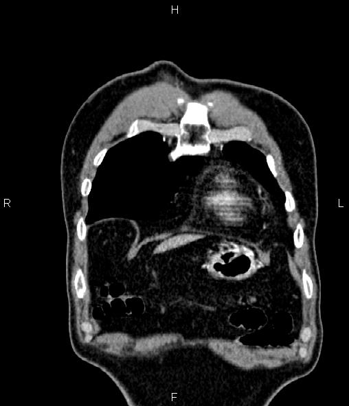 Colon adenocarcinoma (Radiopaedia 83266-97671 C 8).jpg