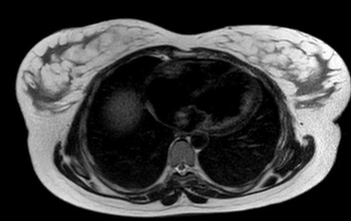 Colon adenocarcinoma with Krukenberg tumors, advanced pregnancy (Radiopaedia 67279-76645 Axial T2 84).jpg