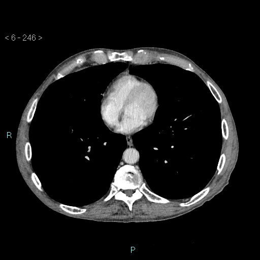 Colonic cancer (ultrasound and TC imaging) (Radiopaedia 50346-55713 B 246).jpg