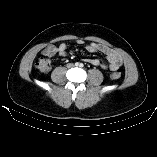 Colonic lipoma with colo-colic intussusception (Radiopaedia 58944-66200 A 40).jpg