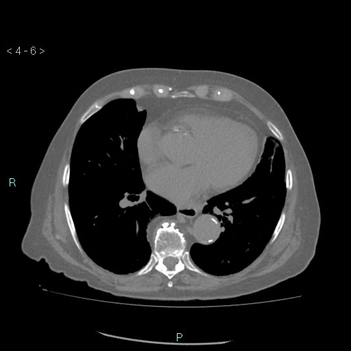 File:Colonic lipomas (Radiopaedia 49137-54244 Axial bone window 4).jpg