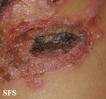 File:Impetigo (Dermatology Atlas 63).jpg