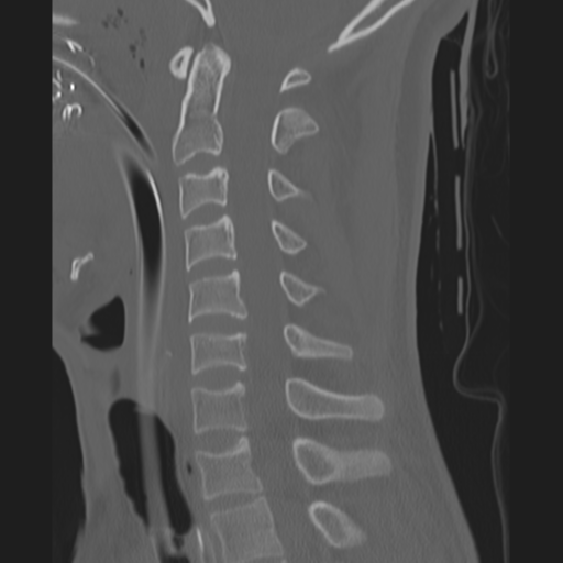 File:Multitrauma with diffuse axonal injury, temporal bone fractures and traumatic caroticocavernous fistula (Radiopaedia 37242-39035 Axial 231).png