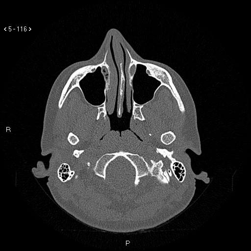 Nasolabial cyst (Radiopaedia 75125-86194 Axial bone window 77).jpg
