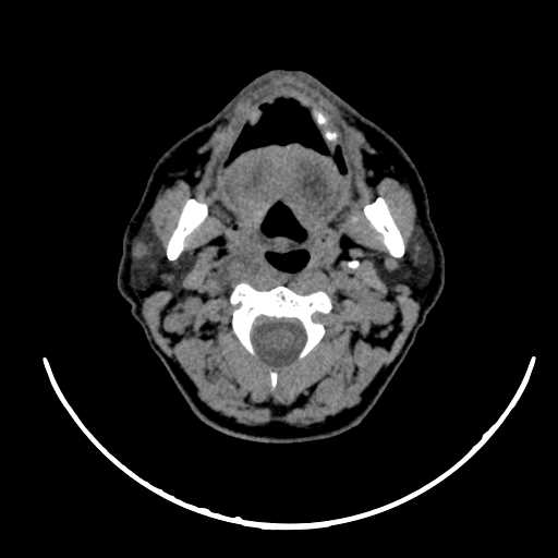 File:Nasopharyngeal carcinoma - infiltrating the clivus (Radiopaedia 62583-70875 Axial non-contrast 27).jpg