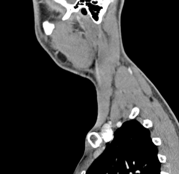 File:Nasopharyngeal carcinoma with skull base invasion (Radiopaedia 53415-59705 C 9).jpg