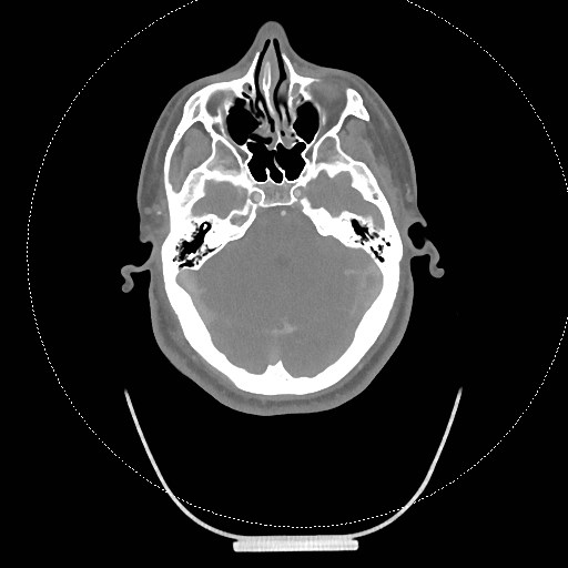 Neck CT angiogram (intraosseous vascular access) (Radiopaedia 55481-61945 B 278).jpg