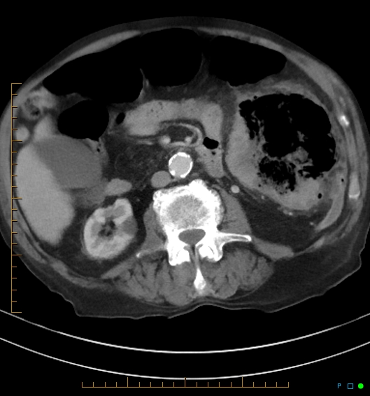 Necrotzing fasciitis due to a perforated adenocarcinoma of the splenic flexure (Radiopaedia 46930-51455 A 33).jpg