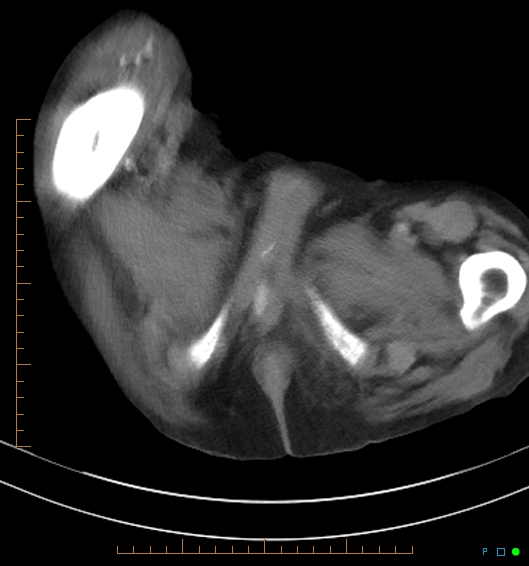 Necrotzing fasciitis due to a perforated adenocarcinoma of the splenic flexure (Radiopaedia 46930-51455 A 70).jpg