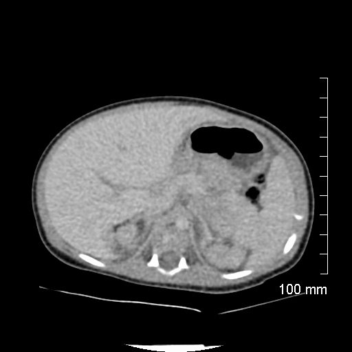 File:Neonatal neuroblastoma (Radiopaedia 56651-63438 Axial non-contrast 27).jpg