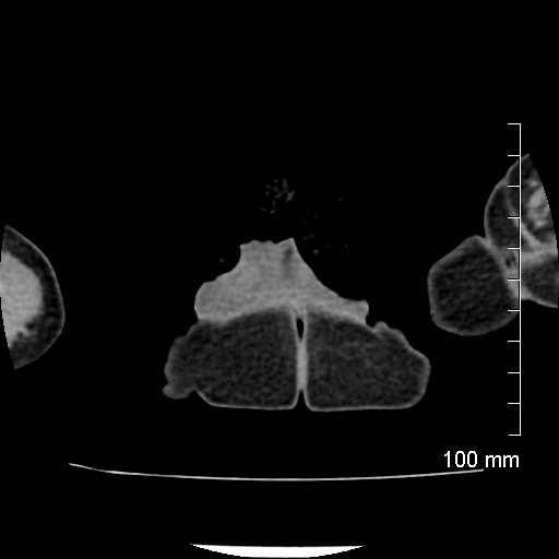 File:Neonatal neuroblastoma (Radiopaedia 56651-63438 Axial non-contrast 98).jpg