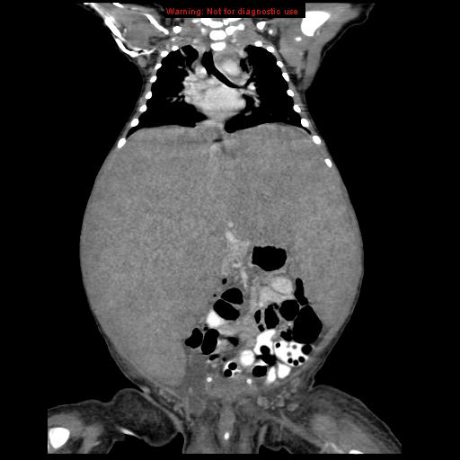 File:Neonatal neuroblastoma (Radiopaedia 9564-10223 B 66).jpg