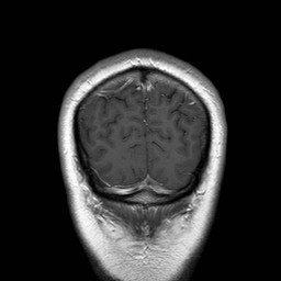 File:Neuro-Behcet's disease (Radiopaedia 21557-21505 Coronal T1 C+ 21).jpg