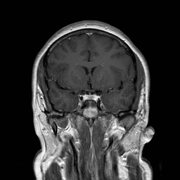File:Neuro-Behcet's disease (Radiopaedia 21557-21505 Coronal T1 C+ 7).jpg